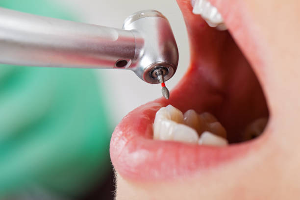 Best Emergency Wisdom Teeth Removal in Redlands, CO